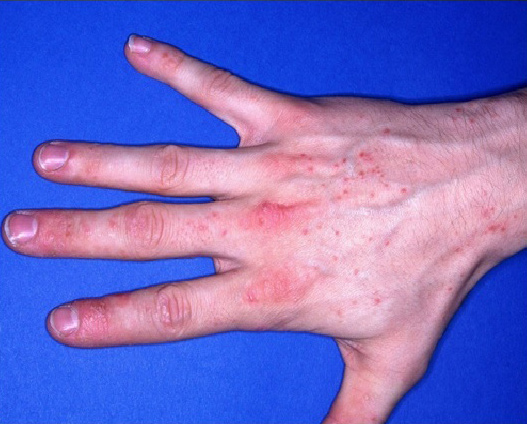 Hand rote Punkte Ekzem
